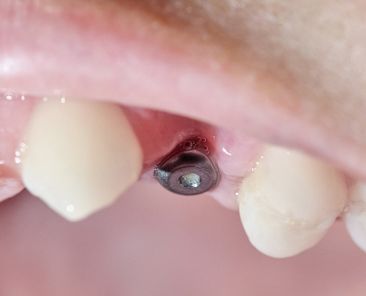 Infektion bei Zahnimplantaten